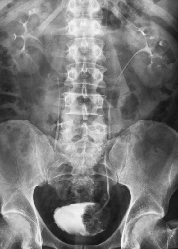 A urogram, which uses x-rays to image the urinary tract, helps identify urethral stenosis.