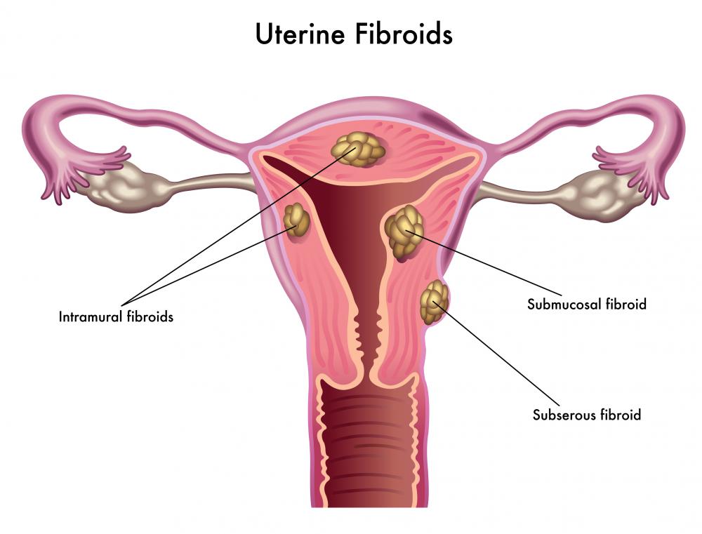 Intramural, submucosal, and subserosal fibroids are three types of fibroid cysts that grow inside and outside the uterus.
