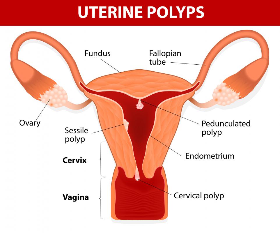 Most of the time, uterine polyps cause no noticeable symptoms.