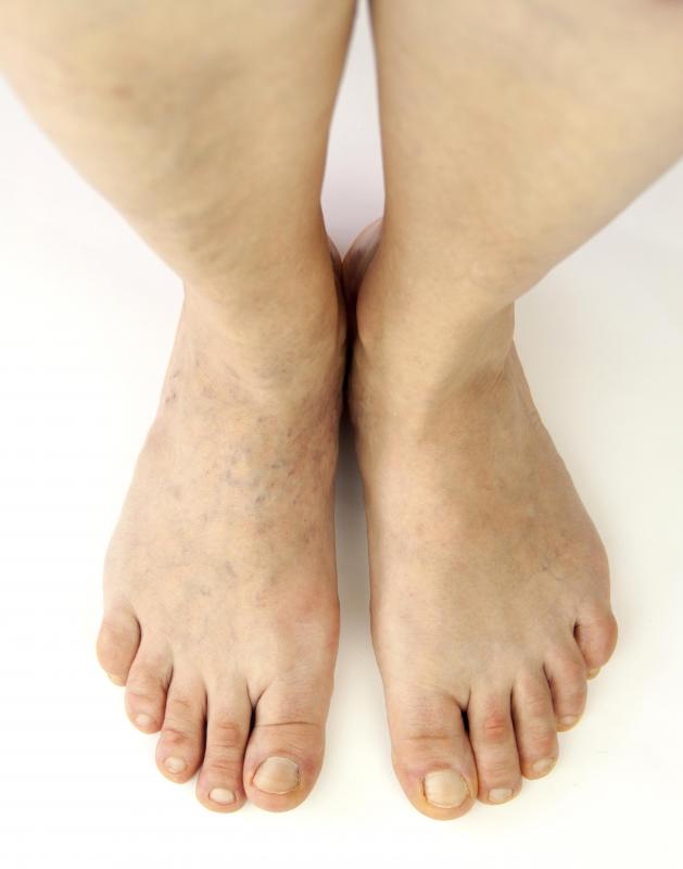 Pregnant women commonly experience swelling in their legs.