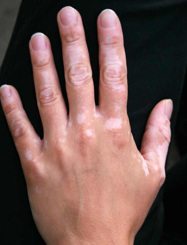 Tacrolimus can be used to treat vitiligo.