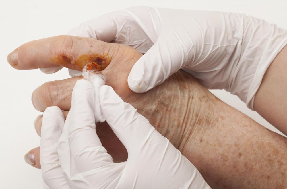 An untreated copperhead snake bite may cause permanent muscle damage.