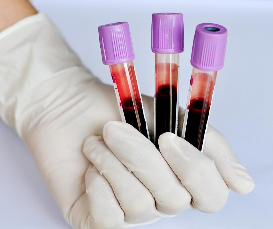 Blood tests may be conducted to screen for infections associated with swollen lymph glands.