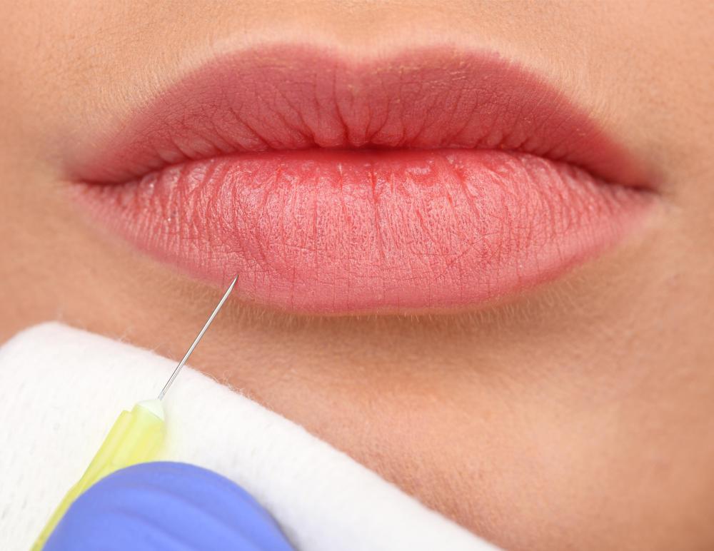 Collagen lip injections may last up to six months.