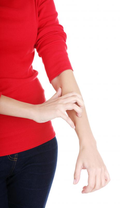 Itchiness may occur as a result of exposure to poison ivy.