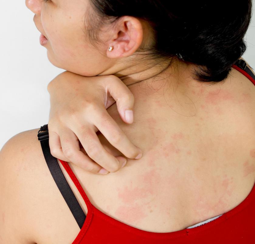 Side effects of allergy shots may include itchiness.