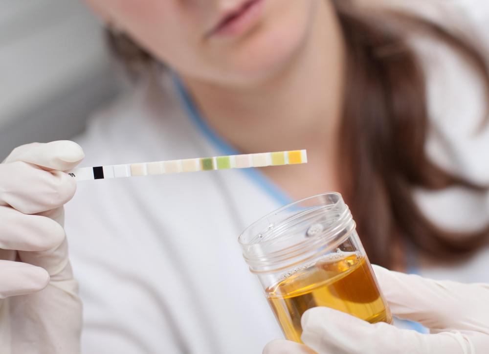 Cloudy urine while wearing a catheter may be an indicator of a urinary tract infection.