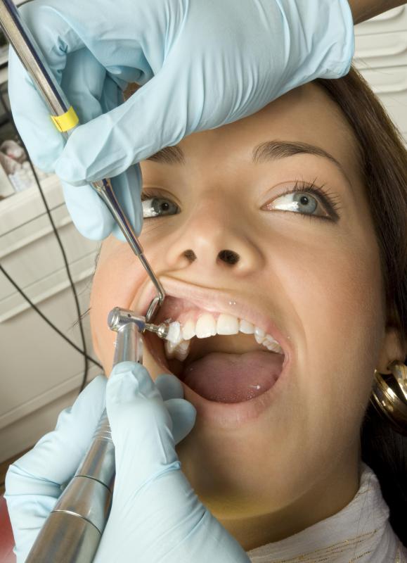 The second part of a dental prophylaxis involves polishing the teeth to smooth over any rough spots.