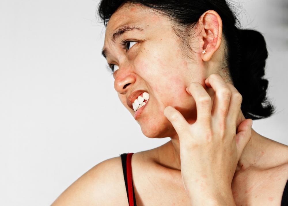 Antihistamines might relieve the itching of dermatitis.