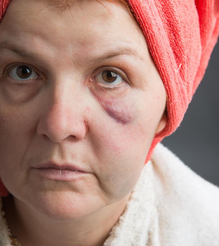 In some places, the extent of a victim's injuries determine whether or not an act of domestic violence is considered a felony or misdemeanor.