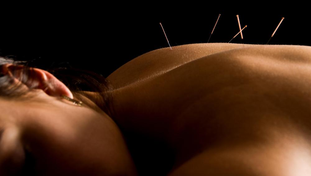 Acupuncture may be offered at wellness centers and clinics.