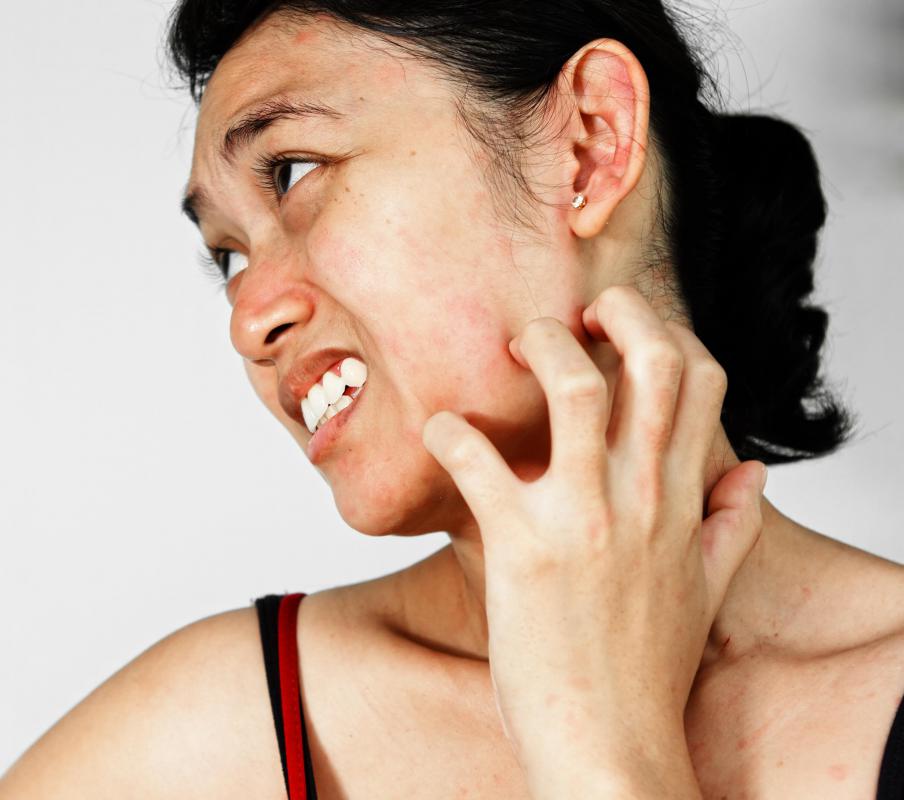 Signs of a tetracycline allergy may include the development of an itchy rash.