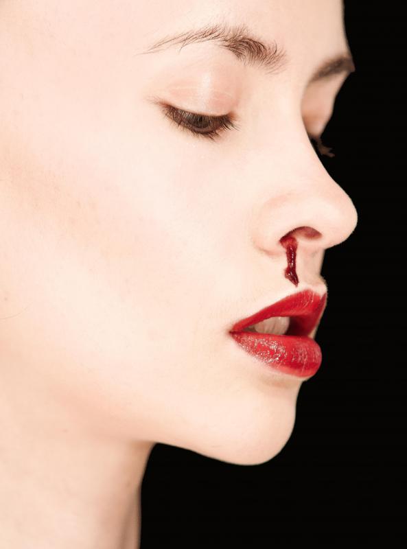 Symptoms of NK T-cell lymphoma can include necrosis in the nasal cavity leading to nose bleeds.
