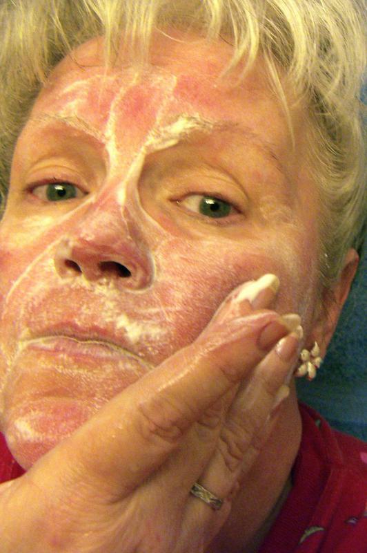 It is thought that perioral dermatitis is actually a form of rosacea.