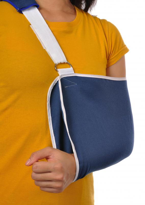 To avoid the formation of a clavicle bone lump, a sling can be used to help the bone heal properly.