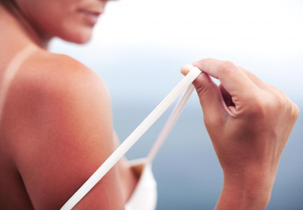Doxycyclin may cause a phototoxic reaction, which may appear very similar to severe sunburn.