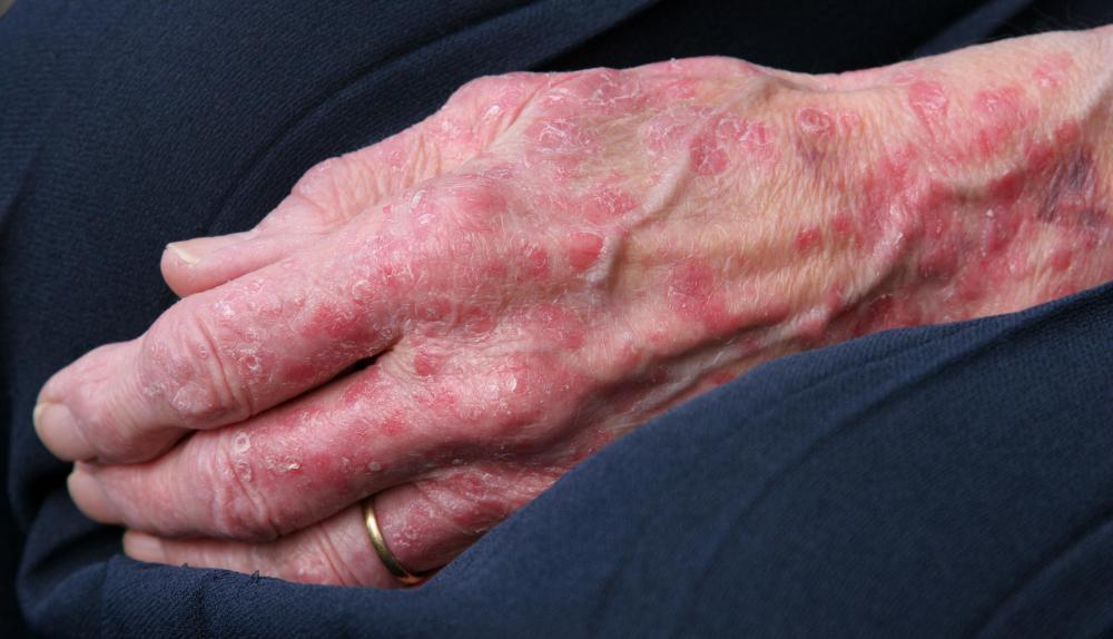 Skin atrophy may lead to rashes and other complications.