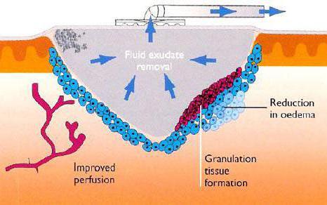 A wound VAC applies negative pressure to the wound and promotes healing.