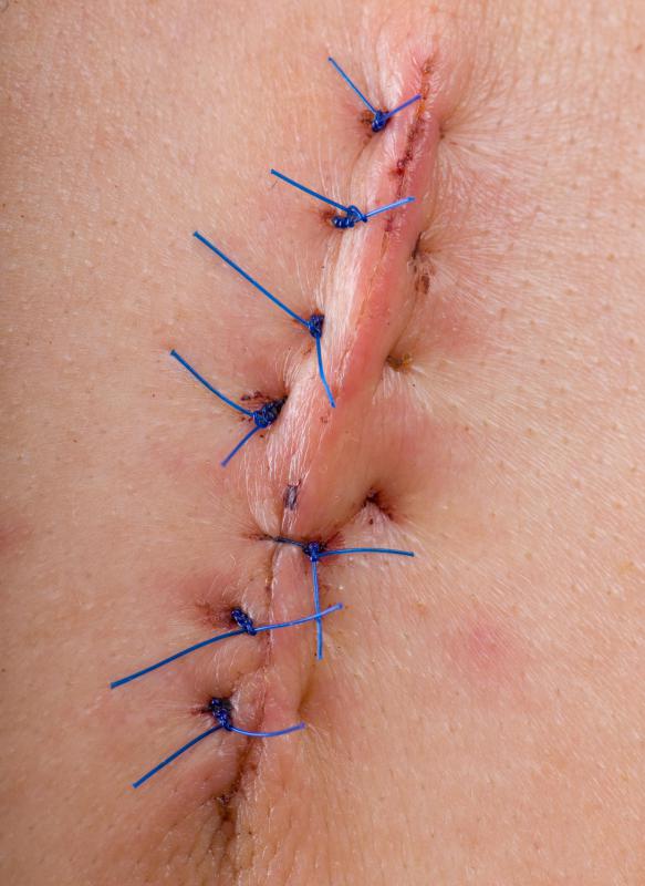A wound may be sutured closed to promote healing.