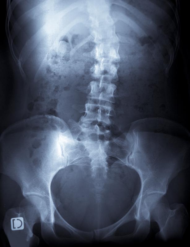 Scoliosis causes curvature of the spine.