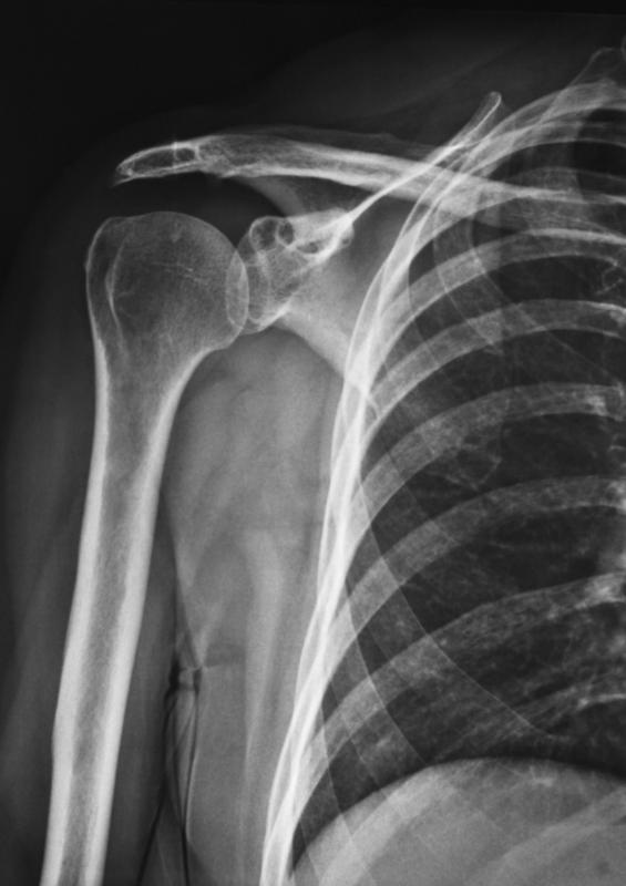 Osteoclasts are cells that break down old bone cells to make way for osteoblasts to stimulate new bone growth.