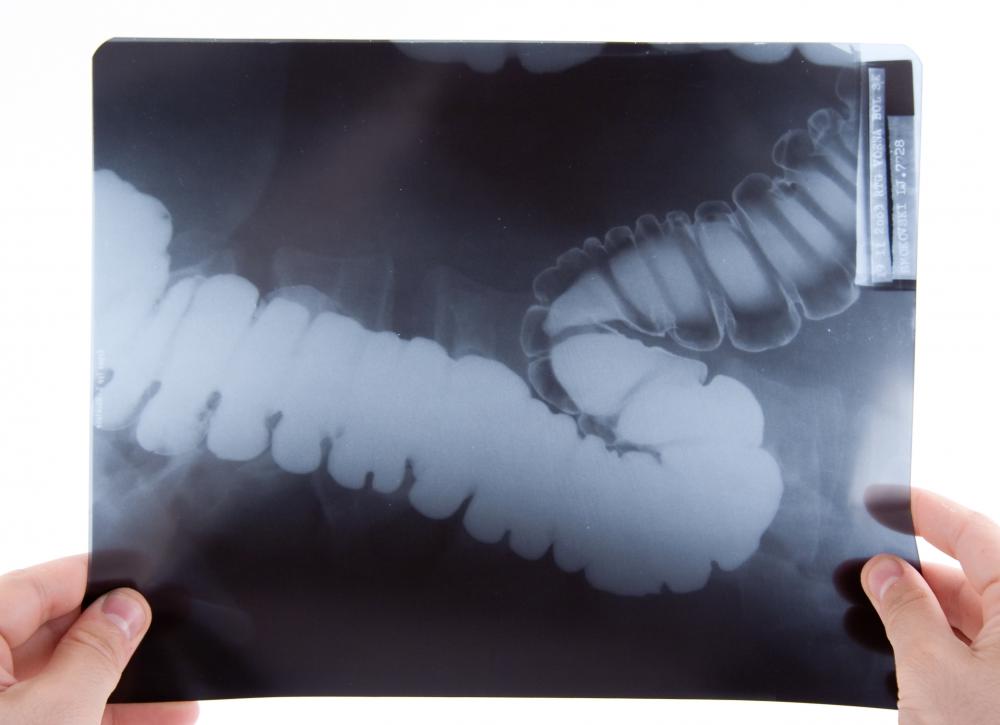 X-rays may be used to look at specific areas of the bowel.