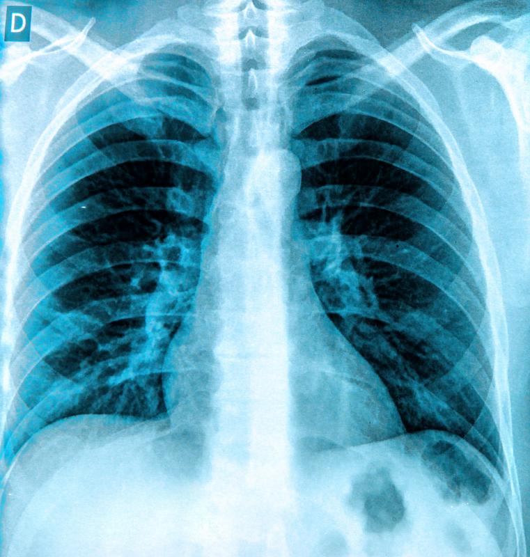 X-rays may be taken to diagnose pleural effusion.