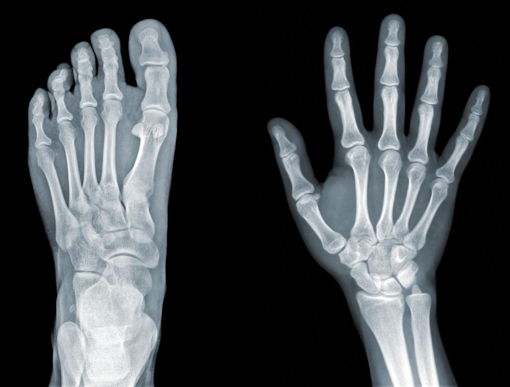 An x-ray may be conducted to diagnose ganglion cysts.