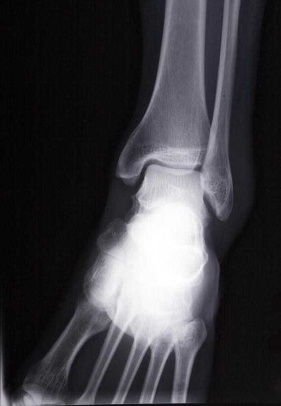 An X-ray may be used to determine the presence of a cuboid bone fracture of the foot.