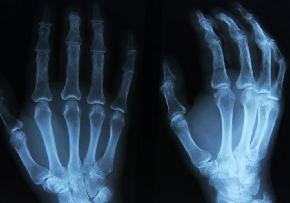 An X-ray should show the extent of an intra-articular fracture.
