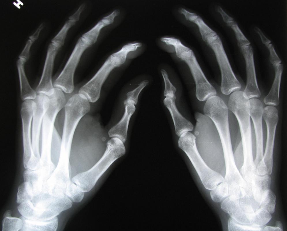 The knuckle condyle is designed to stabilize and strengthen the joint.