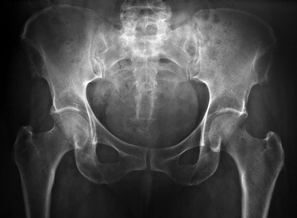 A hip X-ray may be performed to diagnose a hip bone spur.