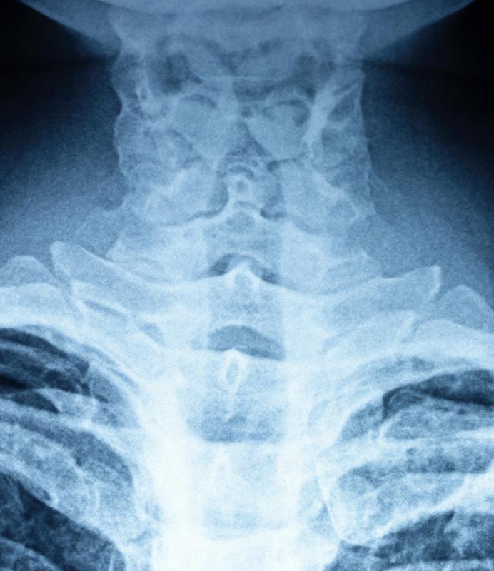 Neck X-rays may be taken in order to diagnose adenoid hypertrophy.