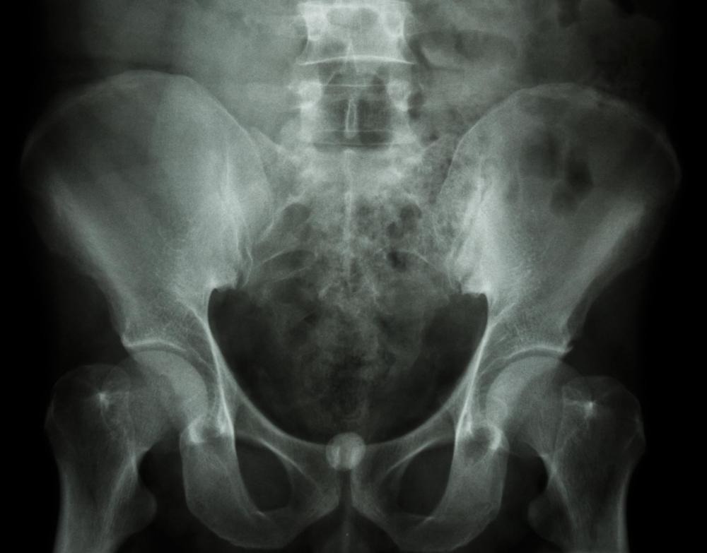 An X-ray of the bladder will need to be taken prior to a cystourethroscopy.