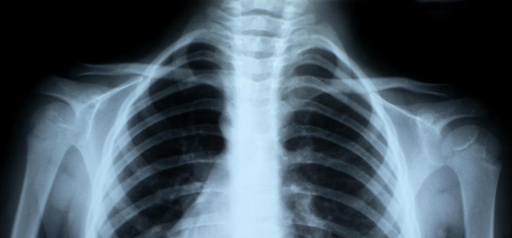 Formation of the collarbone occurs through intramembranous ossification.