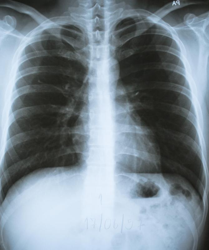 An X-ray of the sternum may be conducted to diagnose a lump on the sternum.