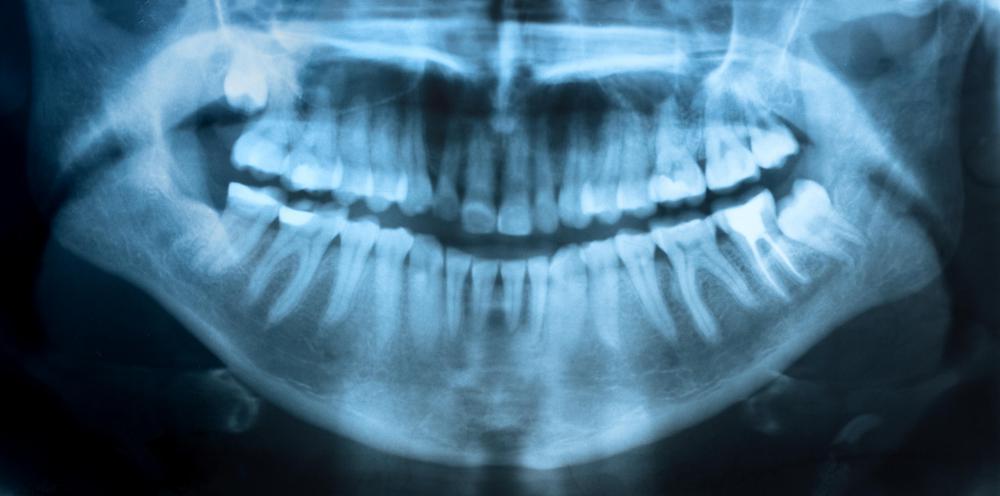 Dental insurance may cover dental x-rays.