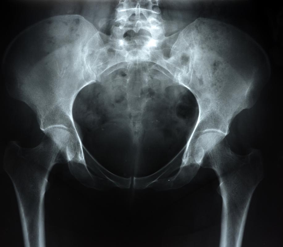 Paraaortic lymph nodes help drain pelvis organs.