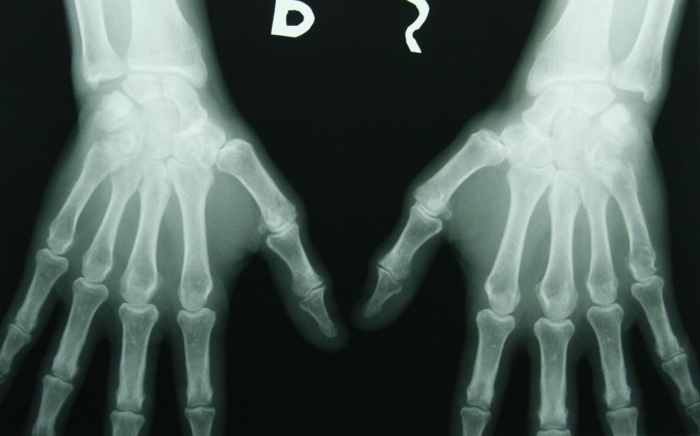 X-rays are high electromagnetic frequency waves used to look inside the human body.
