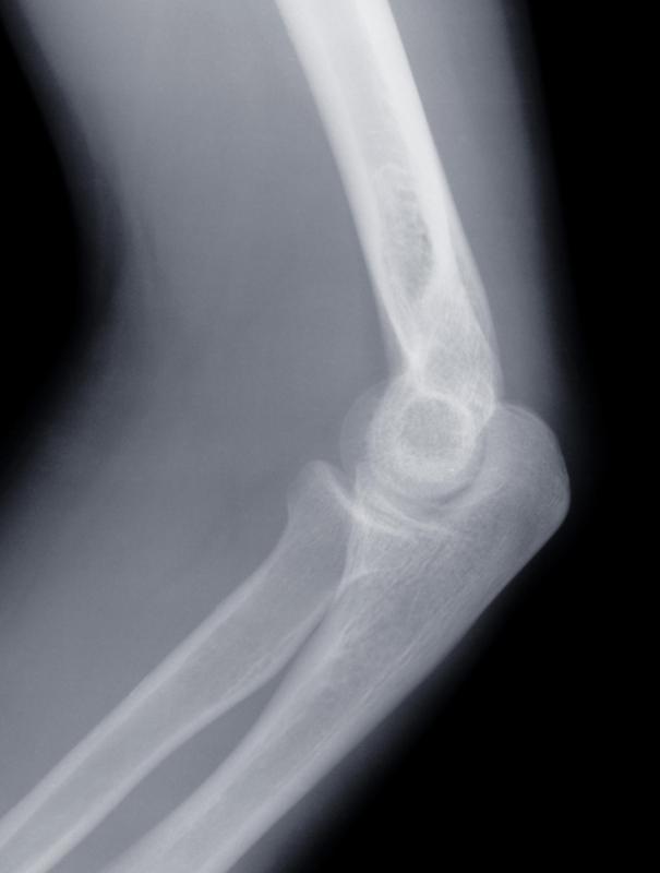 Knee cysts caused by arthritis can be identified with an x-ray.