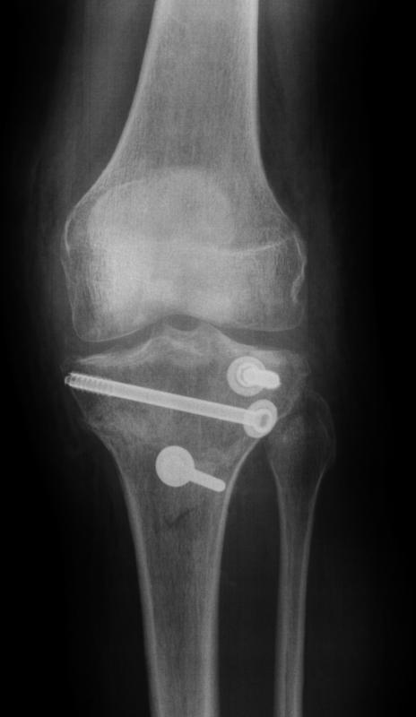Diaphyseal fractures can be repaired using a plate or screws.