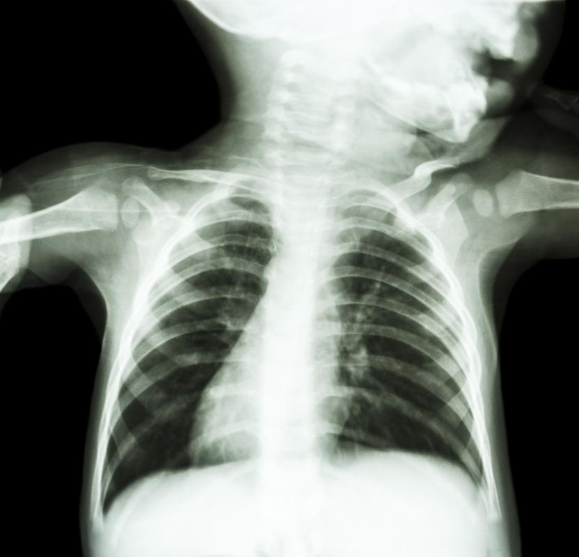 If arthrogryposis multiplex congenita is suspected in the womb, once the baby is born X-rays may be taken to gauge the severity and look for an underlying cause.