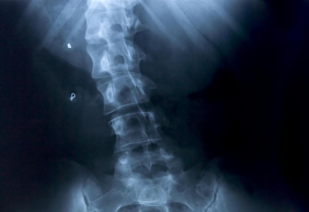 Skeletal deformities, including a curved spine, are signs of rickets.