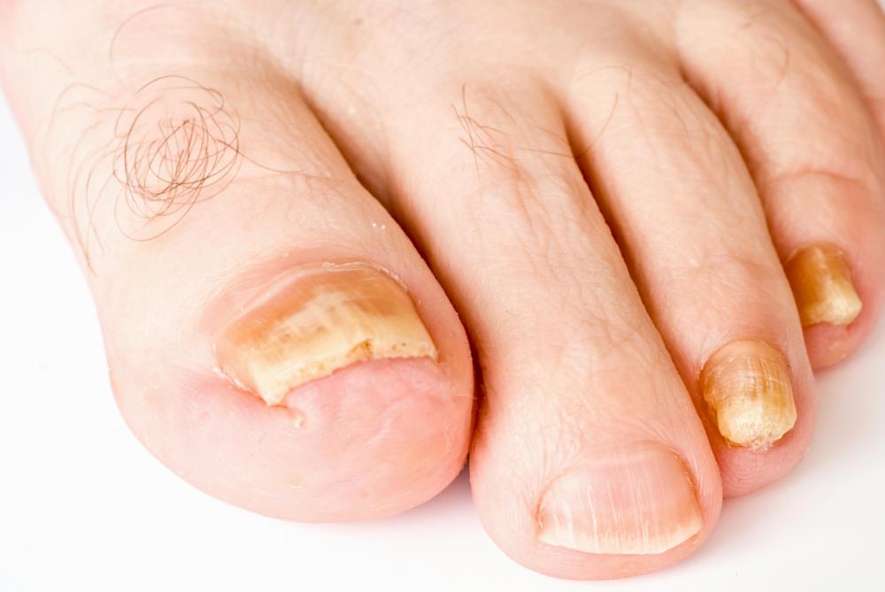 Discolored toenails may be due to a fungal infection, or a symptom of a medical issue such as diabetes.