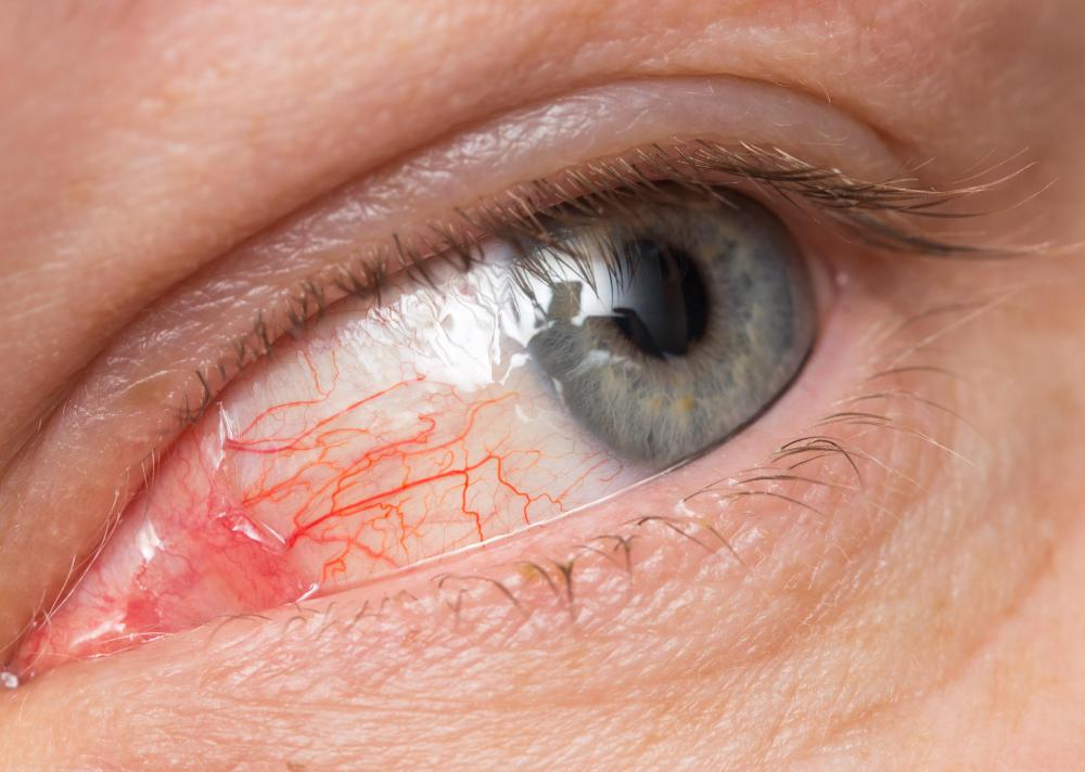 What Is Midfacial Hypoplasia? (with pictures)