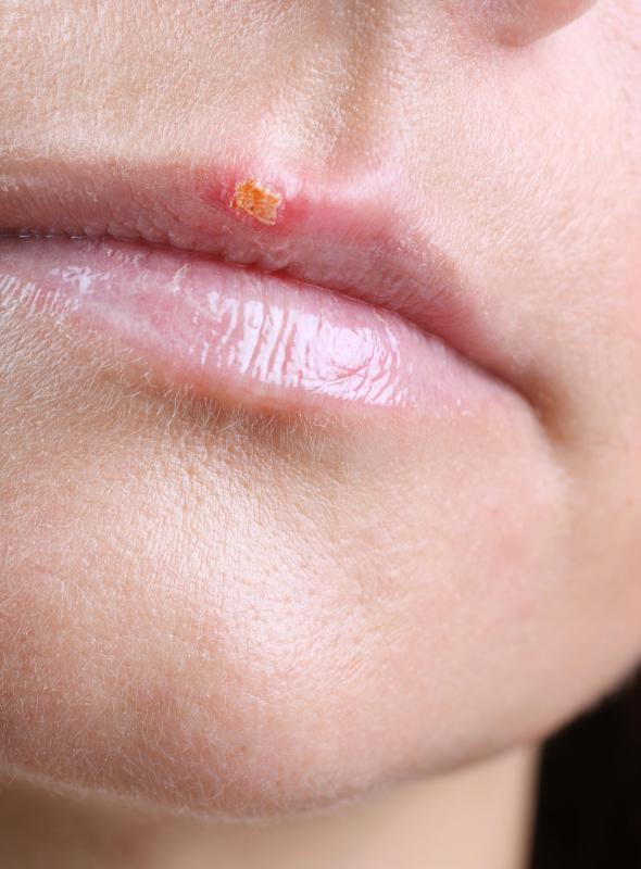 What Are Common Swollen Lip Causes With Pictures