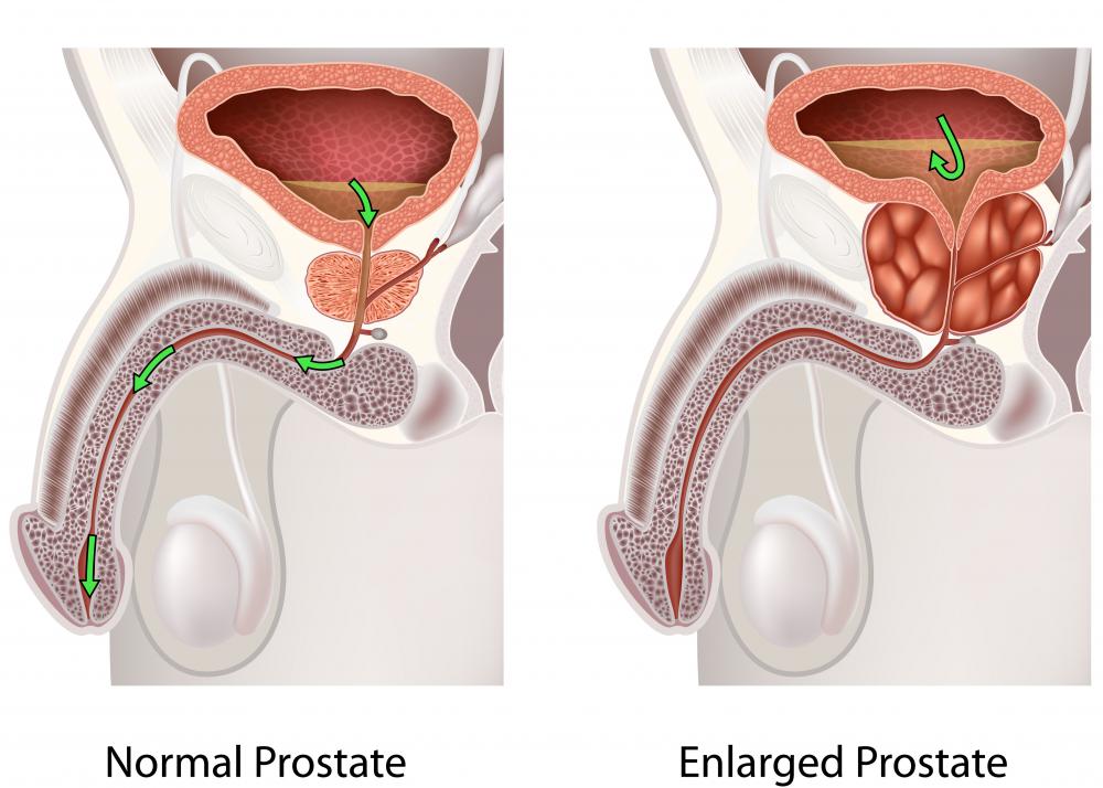 Prostatitis gynecomastia