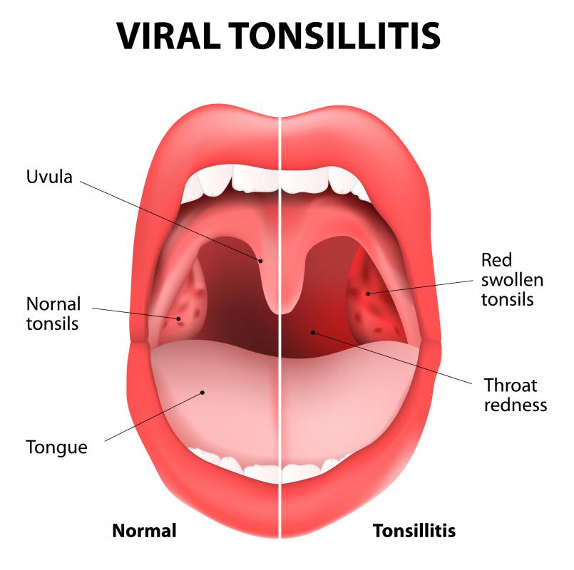 does-amoxicillin-treat-tonsillitis