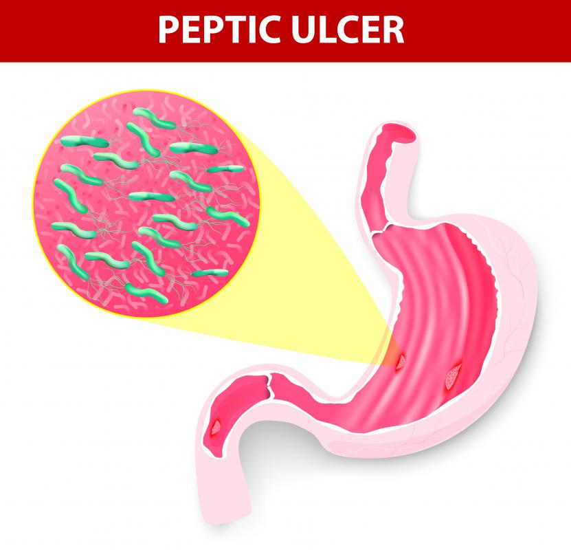 peptické vředy se vyskytují v důsledku nadměrné produkce kyseliny v zažívacím traktu.