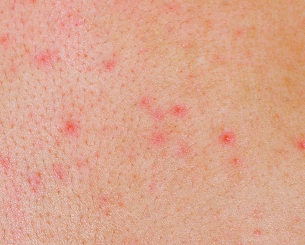 What Causes Itchy Skin Rashes With Pictures